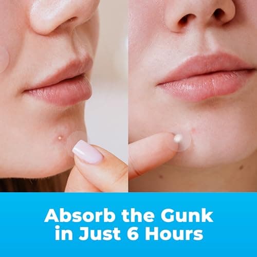 PatchRx Pimple Patches for Face (120 Patches), Hydrocolloid Acne Patches with Tea Tree Oil, Pimple Patch Pimple Stickers - Hydrocolloid Patch Acne Dots - Acne Pimple Patches For Fa thumbnail 2